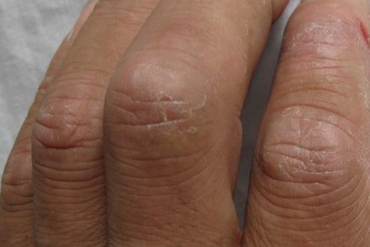 手部湿疹手指关节硬皮干裂图 手部湿疹手指关节硬皮干裂图