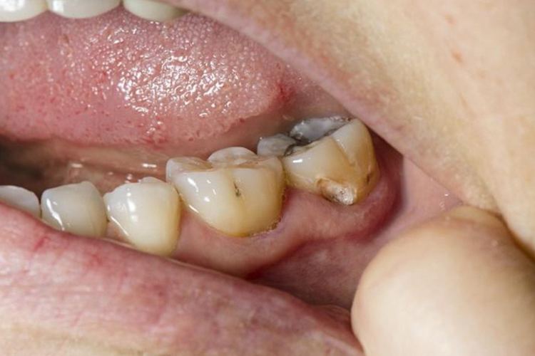 大牙侧面有牙洞图 大牙侧面有牙洞图