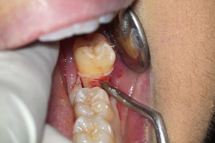 拔牙矫正治疗图 拔牙矫正治疗图