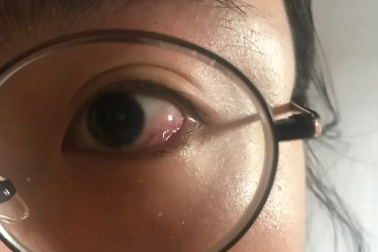 揉眼睛后眼球内有透明鼓起图