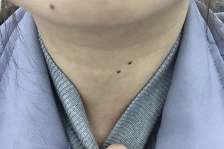 交界痣前颈黑痣图