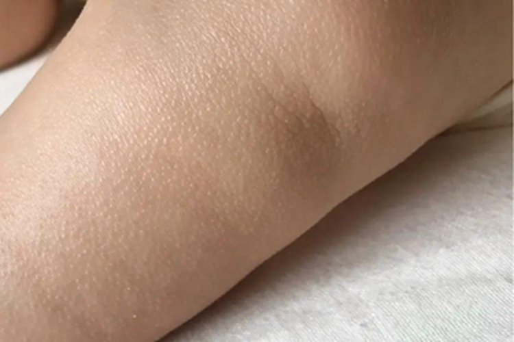 光泽苔藓大腿症状图 光泽苔藓大腿症状图