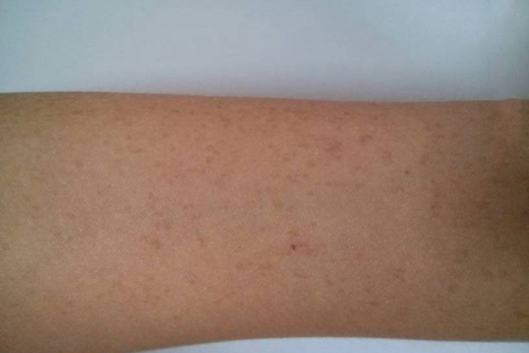 手臂脂溢性角化病图