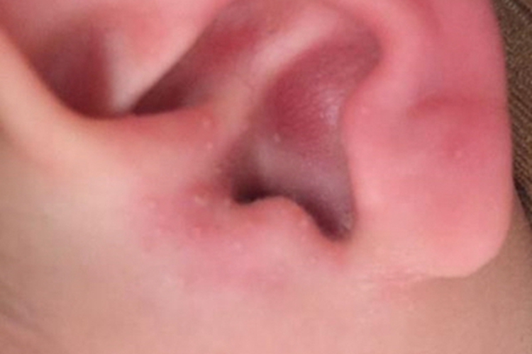 渗出型婴儿湿疹耳部症状图