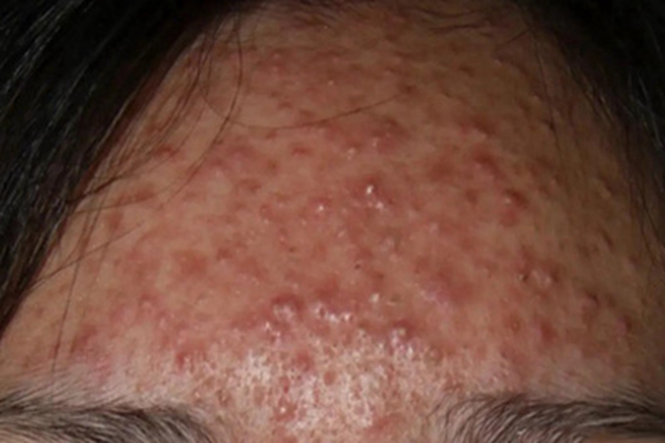 痤疮前额布满红疙瘩图