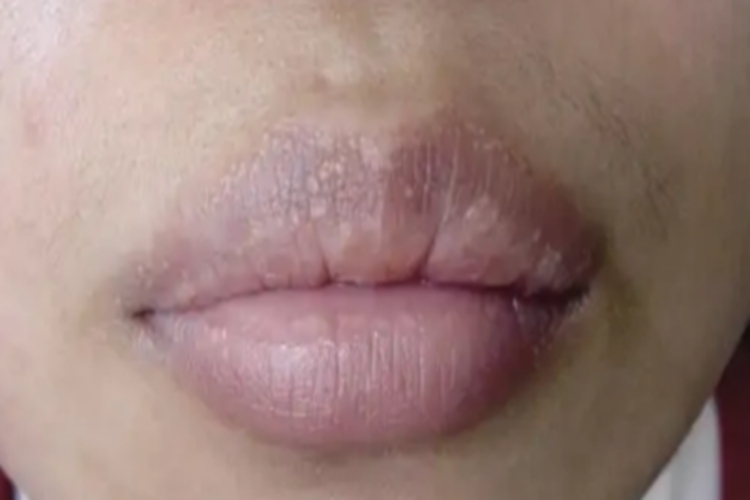 异位皮脂腺唇内侧白斑图 异位皮脂腺唇内侧白斑图