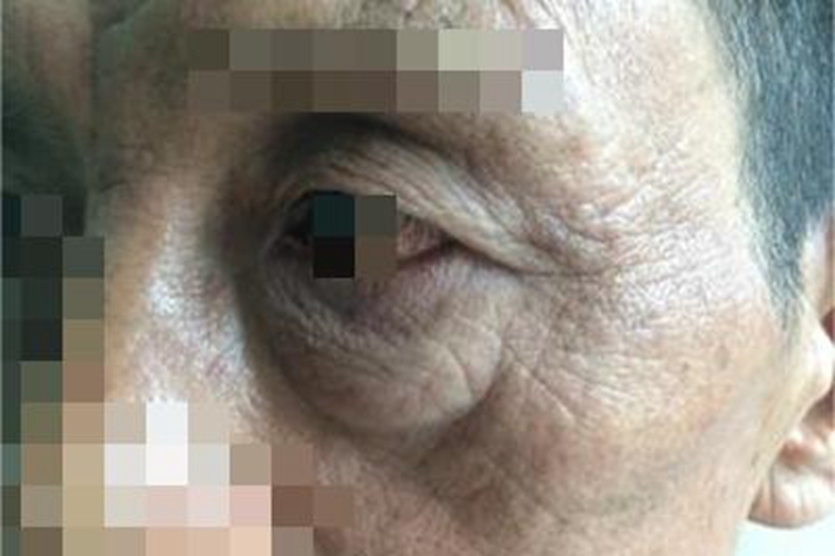 肝硬化眼周症状图