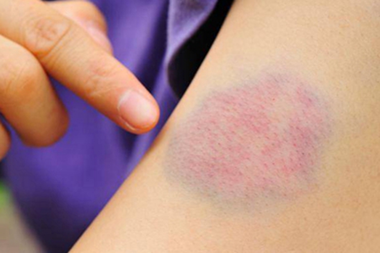 皮肤白血病胳膊斑图