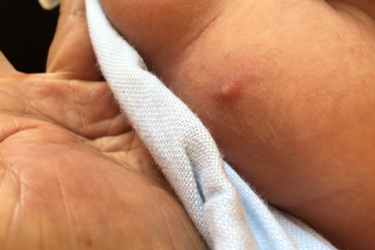 打了水痘疫苗后起脓包图