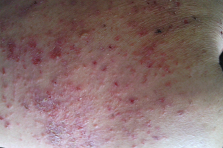 急性湿疹背部症状图