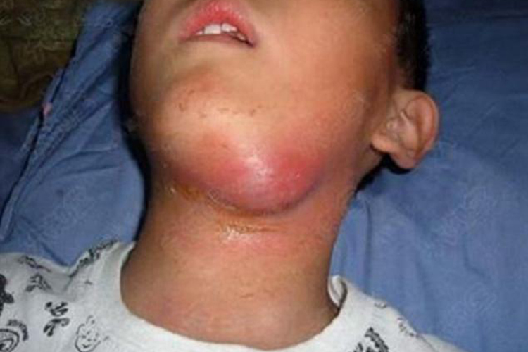 急性颌下淋巴结肿大图