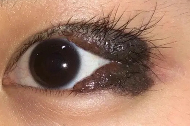 眼睑复合痣睑边缘长黑疙瘩图 眼睑复合痣睑边缘长黑疙瘩图