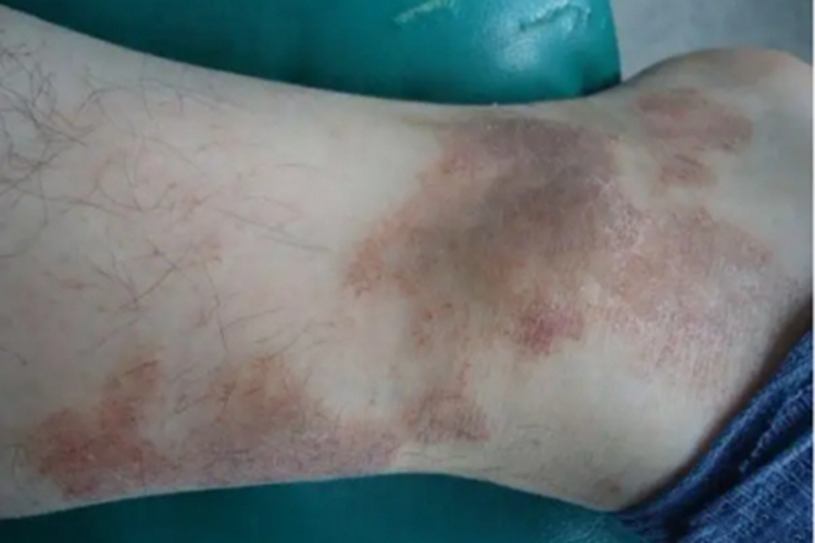 色素性紫癜性苔藓样皮炎脚踝斑图