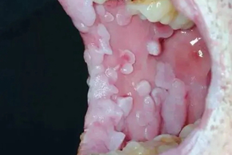 口腔尖锐湿疣口腔症状图