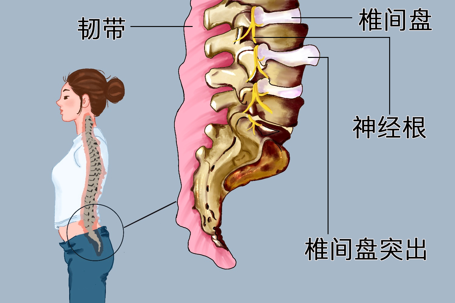 腰椎间盘突出图
