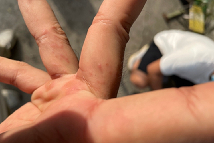 汗疱疹手指缝症状图