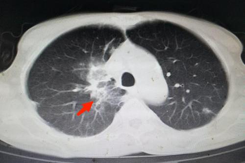 肺脓肿CT图