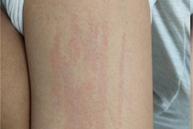 成人Still病大腿症状图 成人Still病大腿症状图