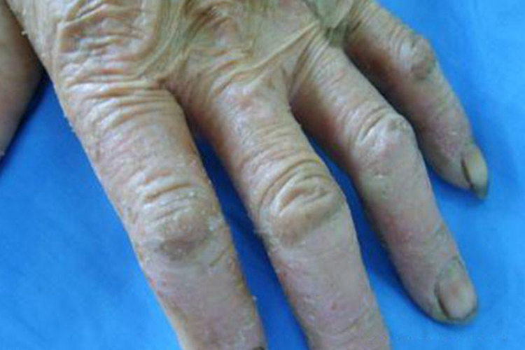 老人慢性湿疹图