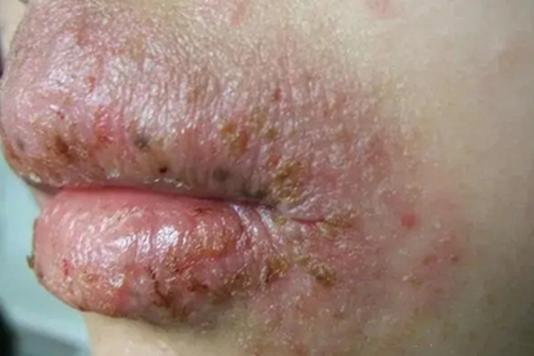 慢性唇炎嘴唇症状图