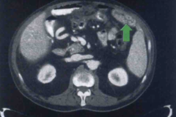 胰腺癌腹膜转移图 胰腺癌腹膜转移图