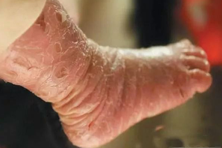 寻常型鱼鳞病腿部裂纹图