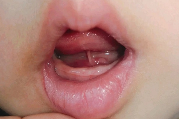 三个月宝宝正常口腔图