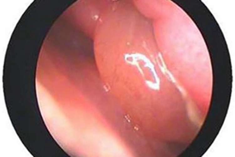 鼻旁窦炎肿块图