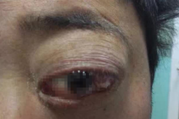 眼眶肿瘤眼部症状图 眼眶肿瘤眼部症状图