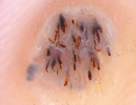 跖疣去除角质栓后有小黑刺图 跖疣去除角质栓后有小黑刺图