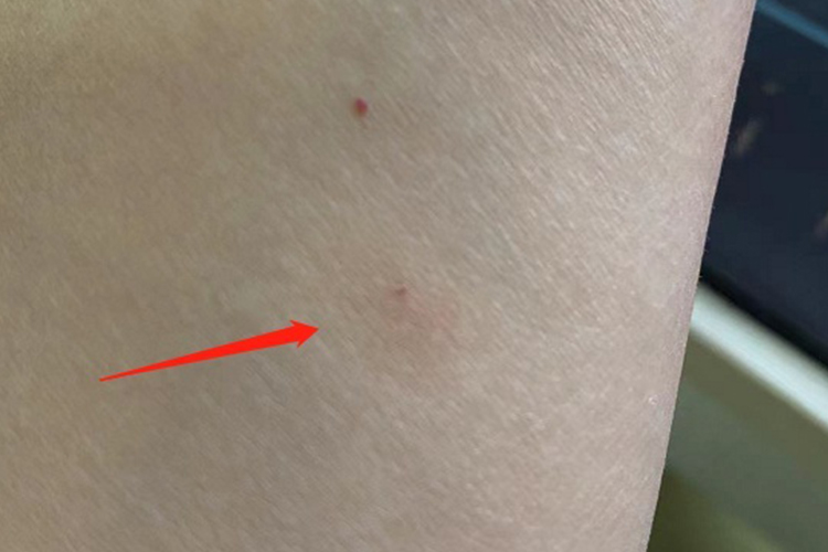 结核菌素试验手臂正常图 结核菌素试验手臂正常图