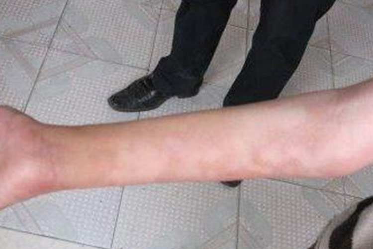 麻风病最初皮损图