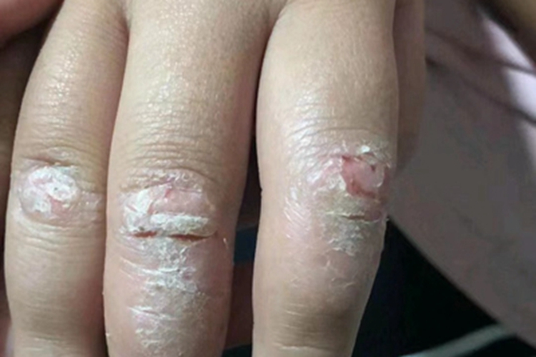 慢性湿疹手部结痂图 慢性湿疹手部结痂图