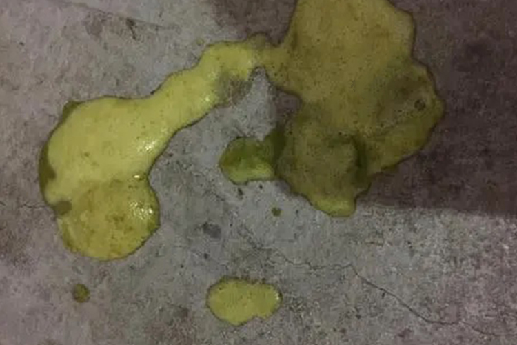 青绿色带泡沫大便图