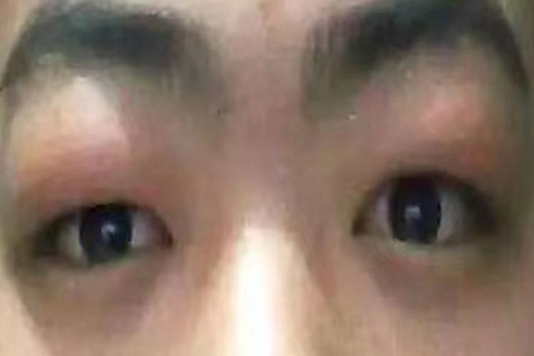 贫血眼睑水肿图