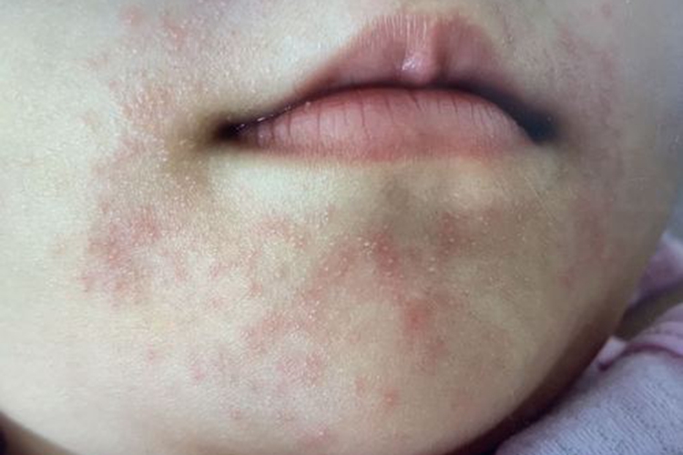 小儿海鲜过敏口周症状图