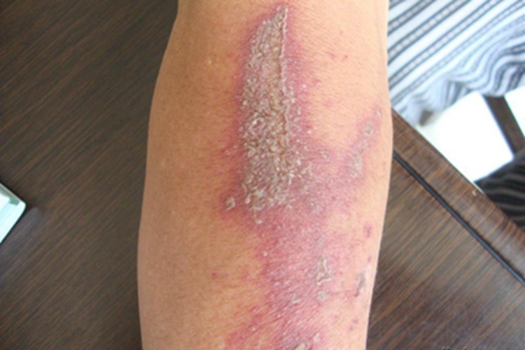 隐翅虫皮炎胳膊症状图