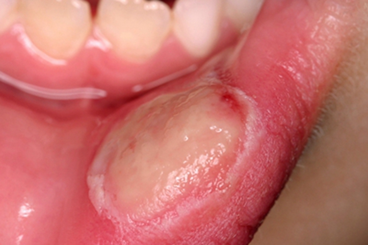糜烂型口腔扁平苔藓症状图