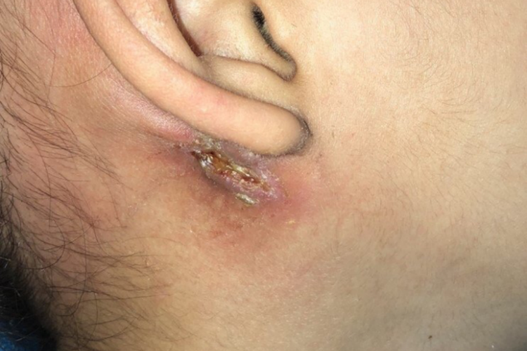 鳃裂瘘局部感染图