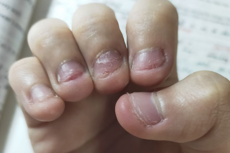 小孩啃手指甲烂手图