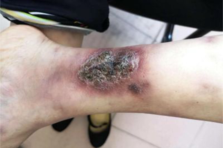 硬红斑左侧小腿外侧结痂图