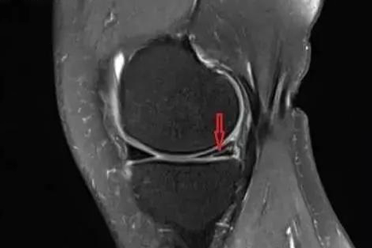 半月板撕裂图 半月板撕裂图