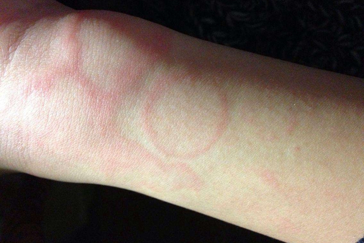 婴儿身上荨麻疹图