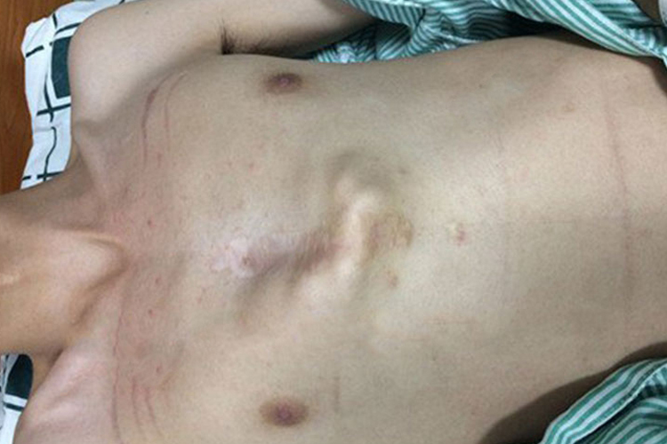 维生素D缺乏性佝偻病鸡胸图