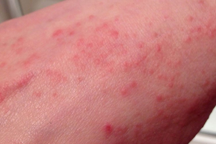 艾滋病急性期红疹图