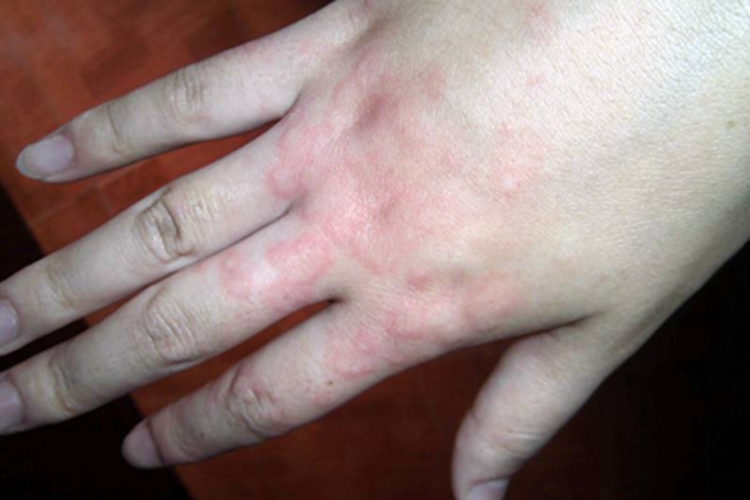 革螨皮炎手背上有风团图