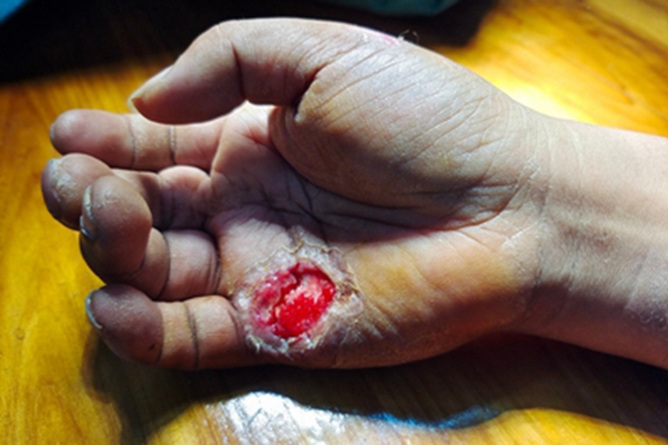 电烧伤手掌缺损图