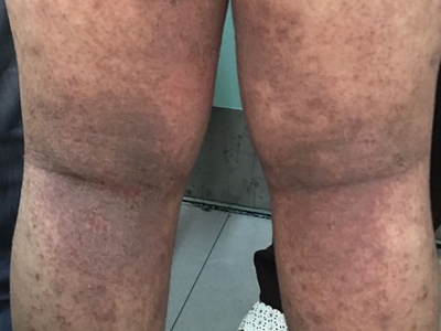 青年成人期特应性皮炎腿上大面积红斑图.jpg