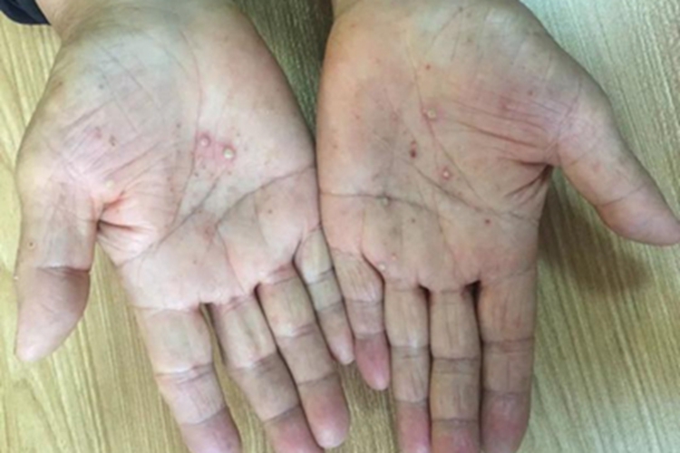 柯萨奇病毒疹水疱图