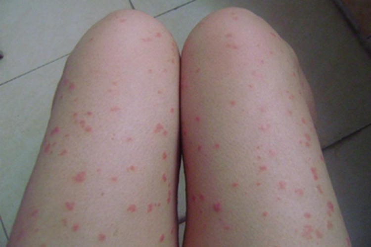 麻疹腿部小红疙瘩图